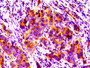 IHC image of CAC13168 diluted at 1:100 and staining in paraffin-embedded human pancreatic cancer performed on a Leica BondTM system. After dewaxing and hydration, antigen retrieval was mediated by high pressure in a citrate buffer (pH 6.0). Section was blocked with 10% normal goat serum 30min at RT. Then primary antibody (1% BSA) was incubated at 4°C overnight. The primary is detected by a biotinylated secondary antibody and visualized using an HRP conjugated SP system. IHC image of CAC13168 diluted at 1:100 and staining in paraffin-embedded human pancreatic cancer performed on a Leica BondTM system. After dewaxing and hydration, antigen retrieval was mediated by high pressure in a citrate buffer (pH 6.0). Section was blocked with 10% normal goat serum 30min at RT. Then primary antibody (1% BSA) was incubated at 4°C overnight. The primary is detected by a biotinylated secondary antibody and visualized using an HRP conjugated SP system.