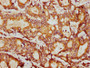 IHC image of CAC13177 diluted at 1:400 and staining in paraffin-embedded human colon cancer performed on a Leica BondTM system. After dewaxing and hydration, antigen retrieval was mediated by high pressure in a citrate buffer (pH 6.0). Section was blocked with 10% normal goat serum 30min at RT. Then primary antibody (1% BSA) was incubated at 4°C overnight. The primary is detected by a biotinylated secondary antibody and visualized using an HRP conjugated SP system. IHC image of CAC13177 diluted at 1:400 and staining in paraffin-embedded human colon cancer performed on a Leica BondTM system. After dewaxing and hydration, antigen retrieval was mediated by high pressure in a citrate buffer (pH 6.0). Section was blocked with 10% normal goat serum 30min at RT. Then primary antibody (1% BSA) was incubated at 4°C overnight. The primary is detected by a biotinylated secondary antibody and visualized using an HRP conjugated SP system.