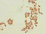 Immunohistochemistry of paraffin-embedded human breast cancer using CAC13190 at dilution of 1:100