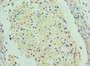 Immunohistochemistry of paraffin-embedded human cervical cancer using CAC13193 at dilution of 1:100