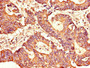 Immunohistochemistry of paraffin-embedded human colon cancer using CAC13198 at dilution of 1:100