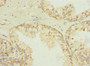 Immunohistochemistry of paraffin-embedded human prostate cancer using CAC13208 at dilution of 1:100