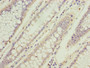Immunohistochemistry of paraffin-embedded human colon cancer using CAC13214 at dilution of 1:100