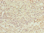Immunohistochemistry of paraffin-embedded human pancreatic cancer using CAC13214 at dilution of 1:100