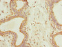 Immunohistochemistry of paraffin-embedded human breast cancer using CAC13223 at dilution of 1:100