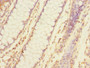Immunohistochemistry of paraffin-embedded human colon cancer using CAC13228 at dilution of 1:100