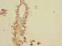 Immunohistochemistry of paraffin-embedded human breast cancer using CAC13228 at dilution of 1:100
