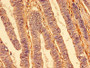 IHC image of CAC13229 diluted at 1:400 and staining in paraffin-embedded human colon cancer performed on a Leica BondTM system. After dewaxing and hydration, antigen retrieval was mediated by high pressure in a citrate buffer (pH 6.0). Section was blocked with 10% normal goat serum 30min at RT. Then primary antibody (1% BSA) was incubated at 4°C overnight. The primary is detected by a biotinylated secondary antibody and visualized using an HRP conjugated SP system.