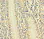 Immunohistochemistry of paraffin-embedded human colon cancer using CAC13243 at dilution of 1:100 Immunohistochemistry of paraffin-embedded human colon cancer using CAC13243 at dilution of 1:100