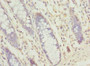 Immunohistochemistry of paraffin-embedded human colon cancer using CAC13258 at dilution of 1:100