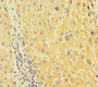 Immunohistochemistry of paraffin-embedded human liver cancer using CAC13261 at dilution of 1:100 Immunohistochemistry of paraffin-embedded human liver cancer using CAC13261 at dilution of 1:100