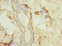 Immunohistochemistry of paraffin-embedded human breast cancer using CAC13262 at dilution of 1:100 Immunohistochemistry of paraffin-embedded human breast cancer using CAC13262 at dilution of 1:100