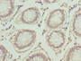 Immunohistochemistry of paraffin-embedded human colon cancer using CAC13267 at dilution of 1:100