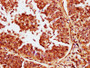 IHC image of CAC13281 diluted at 1:400 and staining in paraffin-embedded human cervical cancer performed on a Leica BondTM system. After dewaxing and hydration, antigen retrieval was mediated by high pressure in a citrate buffer (pH 6.0). Section was blocked with 10% normal goat serum 30min at RT. Then primary antibody (1% BSA) was incubated at 4°C overnight. The primary is detected by a biotinylated secondary antibody and visualized using an HRP conjugated SP system. IHC image of CAC13281 diluted at 1:400 and staining in paraffin-embedded human cervical cancer performed on a Leica BondTM system. After dewaxing and hydration, antigen retrieval was mediated by high pressure in a citrate buffer (pH 6.0). Section was blocked with 10% normal goat serum 30min at RT. Then primary antibody (1% BSA) was incubated at 4°C overnight. The primary is detected by a biotinylated secondary antibody and visualized using an HRP conjugated SP system.