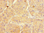 Immunohistochemistry of paraffin-embedded human liver cancer using CAC13350 at dilution of 1:100