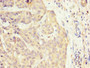 IHC image of CAC13376 diluted at 1:300 and staining in paraffin-embedded human liver cancer performed on a Leica BondTM system. After dewaxing and hydration, antigen retrieval was mediated by high pressure in a citrate buffer (pH 6.0). Section was blocked with 10% normal goat serum 30min at RT. Then primary antibody (1% BSA) was incubated at 4°C overnight. The primary is detected by a biotinylated secondary antibody and visualized using an HRP conjugated SP system. IHC image of CAC13376 diluted at 1:300 and staining in paraffin-embedded human liver cancer performed on a Leica BondTM system. After dewaxing and hydration, antigen retrieval was mediated by high pressure in a citrate buffer (pH 6.0). Section was blocked with 10% normal goat serum 30min at RT. Then primary antibody (1% BSA) was incubated at 4°C overnight. The primary is detected by a biotinylated secondary antibody and visualized using an HRP conjugated SP system.