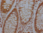IHC image of CAC13380 diluted at 1:100 and staining in paraffin-embedded human colon cancer performed on a Leica BondTM system. After dewaxing and hydration, antigen retrieval was mediated by high pressure in a citrate buffer (pH 6.0). Section was blocked with 10% normal goat serum 30min at RT. Then primary antibody (1% BSA) was incubated at 4°C overnight. The primary is detected by a Goat anti-rabbit polymer IgG labeled by HRP and visualized using 0.05% DAB. IHC image of CAC13380 diluted at 1:100 and staining in paraffin-embedded human colon cancer performed on a Leica BondTM system. After dewaxing and hydration, antigen retrieval was mediated by high pressure in a citrate buffer (pH 6.0). Section was blocked with 10% normal goat serum 30min at RT. Then primary antibody (1% BSA) was incubated at 4°C overnight. The primary is detected by a Goat anti-rabbit polymer IgG labeled by HRP and visualized using 0.05% DAB.
