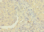 Immunohistochemistry of paraffin-embedded human lung cancer using CAC13427 at dilution of 1:100 Immunohistochemistry of paraffin-embedded human lung cancer using CAC13427 at dilution of 1:100