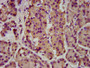 IHC image of CAC13430 diluted at 1:200 and staining in paraffin-embedded human pancreatic cancer performed on a Leica BondTM system. After dewaxing and hydration, antigen retrieval was mediated by high pressure in a citrate buffer (pH 6.0). Section was blocked with 10% normal goat serum 30min at RT. Then primary antibody (1% BSA) was incubated at 4°C overnight. The primary is detected by a biotinylated secondary antibody and visualized using an HRP conjugated SP system. IHC image of CAC13430 diluted at 1:200 and staining in paraffin-embedded human pancreatic cancer performed on a Leica BondTM system. After dewaxing and hydration, antigen retrieval was mediated by high pressure in a citrate buffer (pH 6.0). Section was blocked with 10% normal goat serum 30min at RT. Then primary antibody (1% BSA) was incubated at 4°C overnight. The primary is detected by a biotinylated secondary antibody and visualized using an HRP conjugated SP system.