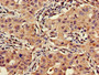 Immunohistochemistry of paraffin-embedded human lung cancer using CAC13437 at dilution of 1:100