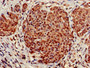Immunohistochemistry of paraffin-embedded human ovarian cancer using CAC13443 at dilution of 1:100 Immunohistochemistry of paraffin-embedded human ovarian cancer using CAC13443 at dilution of 1:100