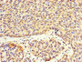 Immunohistochemistry of paraffin-embedded human ovarian cancer using CAC13512 at dilution of 1:100 Immunohistochemistry of paraffin-embedded human ovarian cancer using CAC13512 at dilution of 1:100