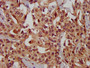 IHC image of CAC13513 diluted at 1:300 and staining in paraffin-embedded human liver cancer performed on a Leica BondTM system. After dewaxing and hydration, antigen retrieval was mediated by high pressure in a citrate buffer (pH 6.0). Section was blocked with 10% normal goat serum 30min at RT. Then primary antibody (1% BSA) was incubated at 4°C overnight. The primary is detected by a biotinylated secondary antibody and visualized using an HRP conjugated SP system.