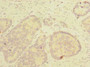 Immunohistochemistry of paraffin-embedded human gastric cancer using CAC13519 at dilution of 1:100 Immunohistochemistry of paraffin-embedded human gastric cancer using CAC13519 at dilution of 1:100