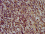 IHC image of CAC13524 diluted at 1:200 and staining in paraffin-embedded human gastric cancer performed on a Leica BondTM system. After dewaxing and hydration, antigen retrieval was mediated by high pressure in a citrate buffer (pH 6.0). Section was blocked with 10% normal goat serum 30min at RT. Then primary antibody (1% BSA) was incubated at 4°C overnight. The primary is detected by a biotinylated secondary antibody and visualized using an HRP conjugated SP system. IHC image of CAC13524 diluted at 1:200 and staining in paraffin-embedded human gastric cancer performed on a Leica BondTM system. After dewaxing and hydration, antigen retrieval was mediated by high pressure in a citrate buffer (pH 6.0). Section was blocked with 10% normal goat serum 30min at RT. Then primary antibody (1% BSA) was incubated at 4°C overnight. The primary is detected by a biotinylated secondary antibody and visualized using an HRP conjugated SP system.