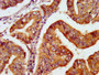 IHC image of CAC13526 diluted at 1:600 and staining in paraffin-embedded human endometrial cancer performed on a Leica BondTM system. After dewaxing and hydration, antigen retrieval was mediated by high pressure in a citrate buffer (pH 6.0). Section was blocked with 10% normal goat serum 30min at RT. Then primary antibody (1% BSA) was incubated at 4°C overnight. The primary is detected by a biotinylated secondary antibody and visualized using an HRP conjugated SP system.