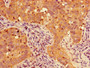 Immunohistochemistry of paraffin-embedded human pancreatic cancer using CAC13534 at dilution of 1:100 Immunohistochemistry of paraffin-embedded human pancreatic cancer using CAC13534 at dilution of 1:100