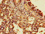 Immunohistochemistry of paraffin-embedded human lung cancer using CAC13534 at dilution of 1:100 Immunohistochemistry of paraffin-embedded human lung cancer using CAC13534 at dilution of 1:100