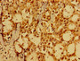 Immunohistochemistry of paraffin-embedded human breast cancer using CAC13535 at dilution of 1:100 Immunohistochemistry of paraffin-embedded human breast cancer using CAC13535 at dilution of 1:100