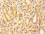 Immunohistochemistry of paraffin-embedded human gastric cancer using CAC13540 at dilution of 1:100 Immunohistochemistry of paraffin-embedded human gastric cancer using CAC13540 at dilution of 1:100