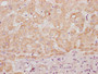 IHC image of CAC13559 diluted at 1:100 and staining in paraffin-embedded human liver tissue performed on a Leica BondTM system. After dewaxing and hydration, antigen retrieval was mediated by high pressure in a citrate buffer (pH 6.0). Section was blocked with 10% normal goat serum 30min at RT. Then primary antibody (1% BSA) was incubated at 4°C overnight. The primary is detected by a Goat anti-rabbit polymer IgG labeled by HRP and visualized using 0.05% DAB. IHC image of CAC13559 diluted at 1:100 and staining in paraffin-embedded human liver tissue performed on a Leica BondTM system. After dewaxing and hydration, antigen retrieval was mediated by high pressure in a citrate buffer (pH 6.0). Section was blocked with 10% normal goat serum 30min at RT. Then primary antibody (1% BSA) was incubated at 4°C overnight. The primary is detected by a Goat anti-rabbit polymer IgG labeled by HRP and visualized using 0.05% DAB.