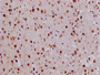 Immunohistochemistry of paraffin-embedded human endometrial cancer using CAC13568 at dilution of 1:100 Immunohistochemistry of paraffin-embedded human endometrial cancer using CAC13568 at dilution of 1:100
