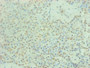 Immunohistochemical of paraffin-embedded human breast cancer using CAC13651 at dilution of 1:200