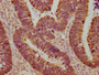 Immunohistochemical of paraffin-embedded human ovarian cancer using CAC13660 at dilution of 1:100 Immunohistochemical of paraffin-embedded human ovarian cancer using CAC13660 at dilution of 1:100