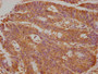 Immunohistochemical of paraffin-embedded human colon cancer using CAC13661 at dilution of 1:50