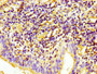 IHC image of CAC13679 diluted at 1:100 and staining in paraffin-embedded human lung cancer performed on a Leica BondTM system. After dewaxing and hydration, antigen retrieval was mediated by high pressure in a citrate buffer (pH 6.0). Section was blocked with 10% normal goat serum 30min at RT. Then primary antibody (1% BSA) was incubated at 4°C overnight. The primary is detected by a biotinylated secondary antibody and visualized using an HRP conjugated SP system. IHC image of CAC13679 diluted at 1:100 and staining in paraffin-embedded human lung cancer performed on a Leica BondTM system. After dewaxing and hydration, antigen retrieval was mediated by high pressure in a citrate buffer (pH 6.0). Section was blocked with 10% normal goat serum 30min at RT. Then primary antibody (1% BSA) was incubated at 4°C overnight. The primary is detected by a biotinylated secondary antibody and visualized using an HRP conjugated SP system.
