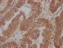 IHC image of CAC13684 diluted at 1:100 and staining in paraffin-embedded human colon cancer performed on a Leica BondTM system. After dewaxing and hydration, antigen retrieval was mediated by high pressure in a citrate buffer (pH 6.0). Section was blocked with 10% normal goat serum 30min at RT. Then primary antibody (1% BSA) was incubated at 4°C overnight. The primary is detected by a biotinylated secondary antibody and visualized using an HRP conjugated SP system. IHC image of CAC13684 diluted at 1:100 and staining in paraffin-embedded human colon cancer performed on a Leica BondTM system. After dewaxing and hydration, antigen retrieval was mediated by high pressure in a citrate buffer (pH 6.0). Section was blocked with 10% normal goat serum 30min at RT. Then primary antibody (1% BSA) was incubated at 4°C overnight. The primary is detected by a biotinylated secondary antibody and visualized using an HRP conjugated SP system.