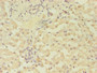Immunohistochemistry of paraffin-embedded human liver cancer using CAC13749 at dilution of 1:100 Immunohistochemistry of paraffin-embedded human liver cancer using CAC13749 at dilution of 1:100