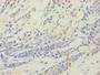 Immunohistochemistry of paraffin-embedded human breast cancer using CAC13760 at dilution of 1:100 Immunohistochemistry of paraffin-embedded human breast cancer using CAC13760 at dilution of 1:100