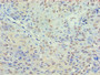 Immunohistochemistry of paraffin-embedded human breast cancer using CAC13761 at dilution of 1:100 Immunohistochemistry of paraffin-embedded human breast cancer using CAC13761 at dilution of 1:100