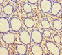 Immunohistochemistry of paraffin-embedded human gastric cancer using CAC13770 at dilution of 1:100 Immunohistochemistry of paraffin-embedded human gastric cancer using CAC13770 at dilution of 1:100