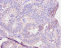 Immunohistochemistry of paraffin-embedded human colon cancer using CAC13777 at dilution of 1:10 Immunohistochemistry of paraffin-embedded human colon cancer using CAC13777 at dilution of 1:10
