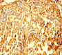 Immunohistochemistry of paraffin-embedded human lung cancer using CAC13788 at dilution of 1:100 Immunohistochemistry of paraffin-embedded human lung cancer using CAC13788 at dilution of 1:100