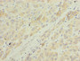 Immunohistochemistry of paraffin-embedded human liver cancer using CAC13812 at dilution of 1:100 Immunohistochemistry of paraffin-embedded human liver cancer using CAC13812 at dilution of 1:100