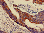 IHC image of CAC13817 diluted at 1:600 and staining in paraffin-embedded human colon cancer performed on a Leica BondTM system. After dewaxing and hydration, antigen retrieval was mediated by high pressure in a citrate buffer (pH 6.0). Section was blocked with 10% normal goat serum 30min at RT. Then primary antibody (1% BSA) was incubated at 4°C overnight. The primary is detected by a biotinylated secondary antibody and visualized using an HRP conjugated SP system. IHC image of CAC13817 diluted at 1:600 and staining in paraffin-embedded human colon cancer performed on a Leica BondTM system. After dewaxing and hydration, antigen retrieval was mediated by high pressure in a citrate buffer (pH 6.0). Section was blocked with 10% normal goat serum 30min at RT. Then primary antibody (1% BSA) was incubated at 4°C overnight. The primary is detected by a biotinylated secondary antibody and visualized using an HRP conjugated SP system.