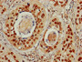 IHC image of CAC13821 diluted at 1:600 and staining in paraffin-embedded human cervical cancer performed on a Leica BondTM system. After dewaxing and hydration, antigen retrieval was mediated by high pressure in a citrate buffer (pH 6.0). Section was blocked with 10% normal goat serum 30min at RT. Then primary antibody (1% BSA) was incubated at 4°C overnight. The primary is detected by a biotinylated secondary antibody and visualized using an HRP conjugated SP system. IHC image of CAC13821 diluted at 1:600 and staining in paraffin-embedded human cervical cancer performed on a Leica BondTM system. After dewaxing and hydration, antigen retrieval was mediated by high pressure in a citrate buffer (pH 6.0). Section was blocked with 10% normal goat serum 30min at RT. Then primary antibody (1% BSA) was incubated at 4°C overnight. The primary is detected by a biotinylated secondary antibody and visualized using an HRP conjugated SP system.